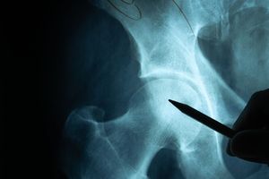 交通事故股骨骨折几级伤残